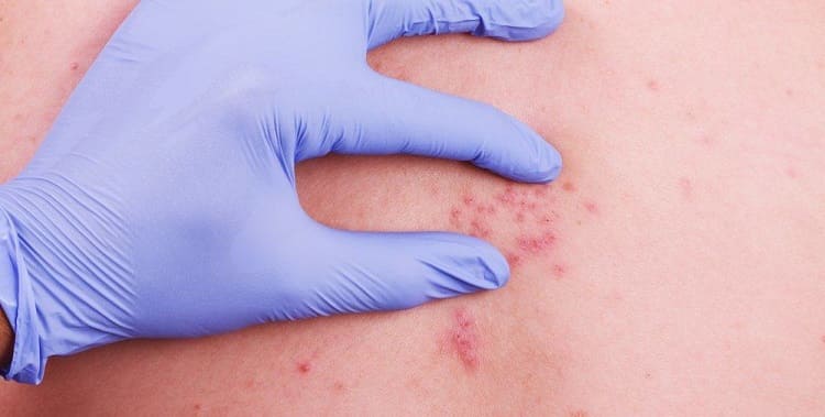 Crema para los herpes en los labios